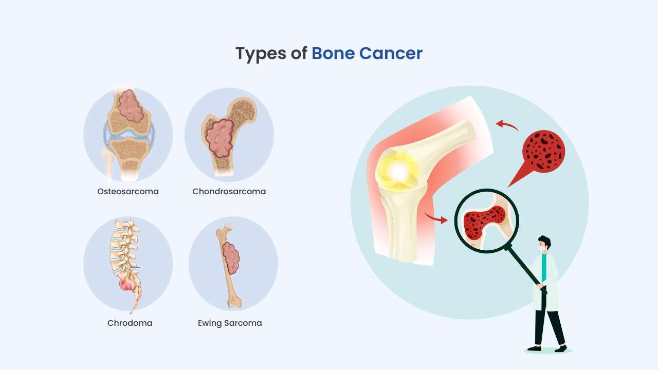 what are the type of bone cancer