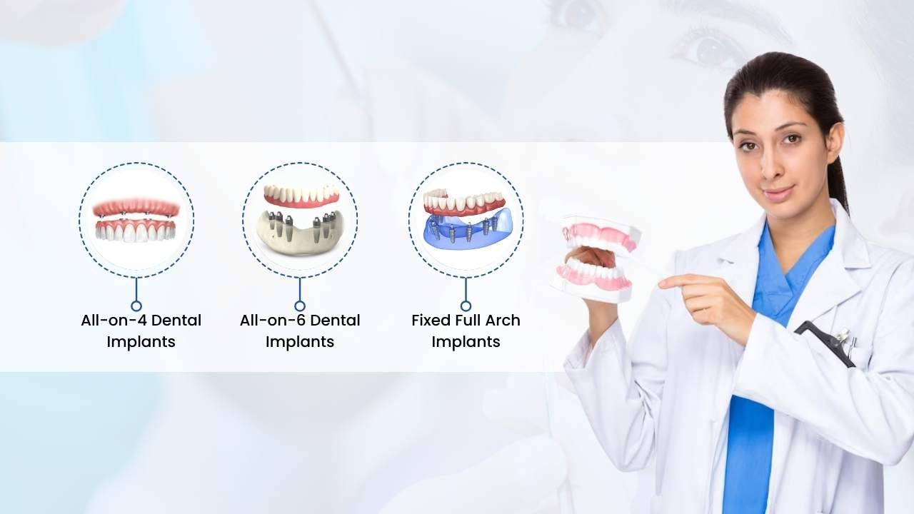 types of full arch dental implants