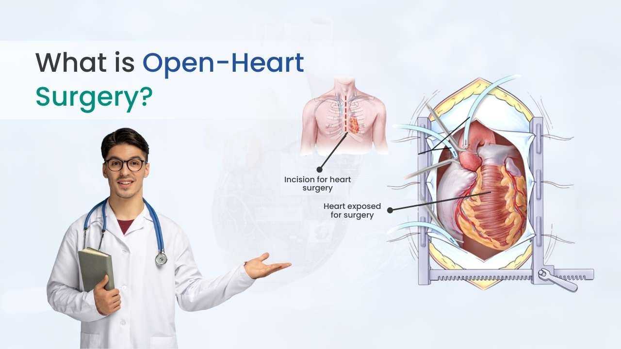 what is open heart surgery
