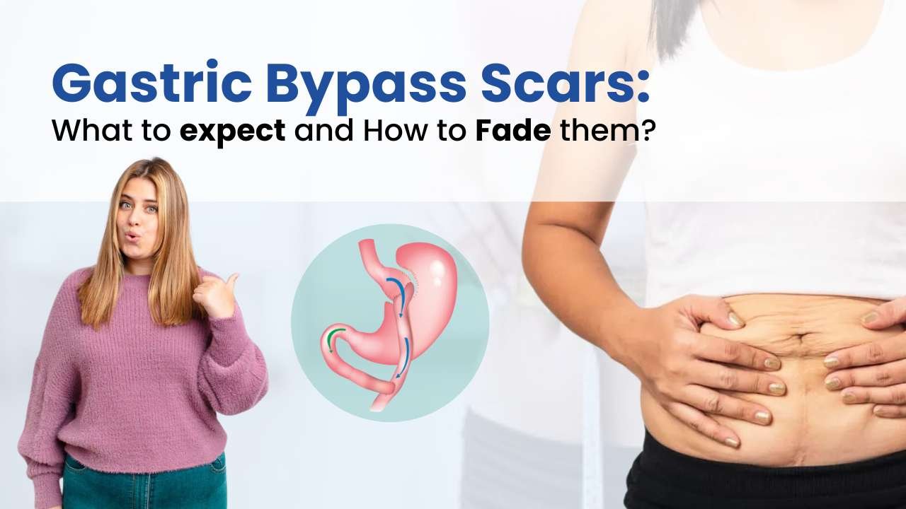 gastric bypass scars what to expect and how to fade them