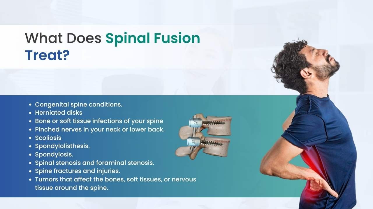 what does spinal fusion treat?