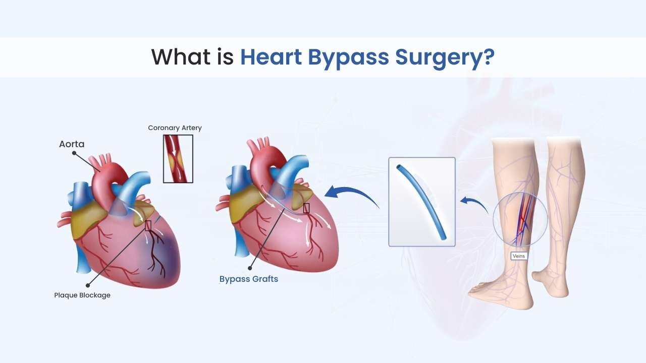 what is heart bypass surgery
