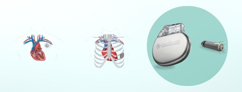 technologies used in india for icd implantation