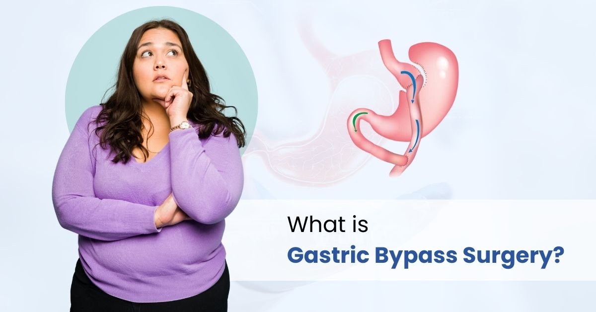 what is gastric bypass surgery?