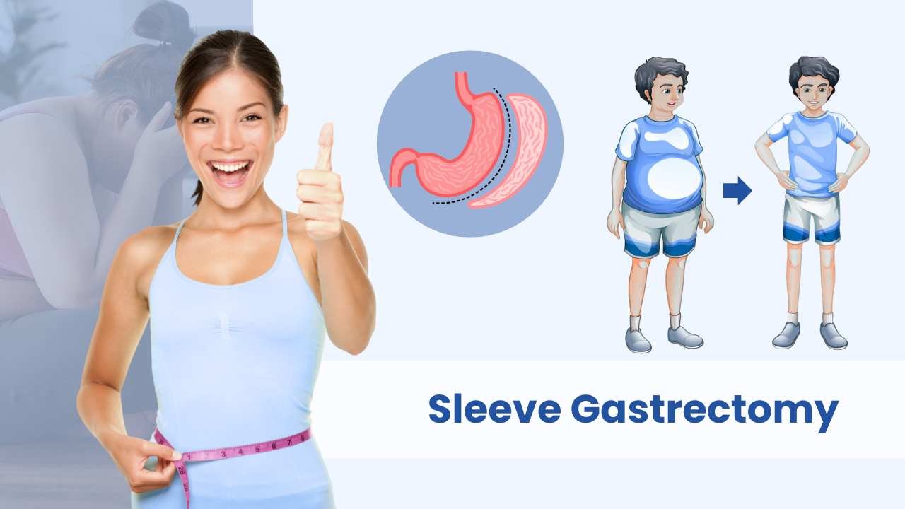 sleeve gastrectomy