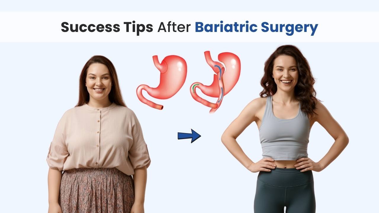 success tip after bariatric surgery