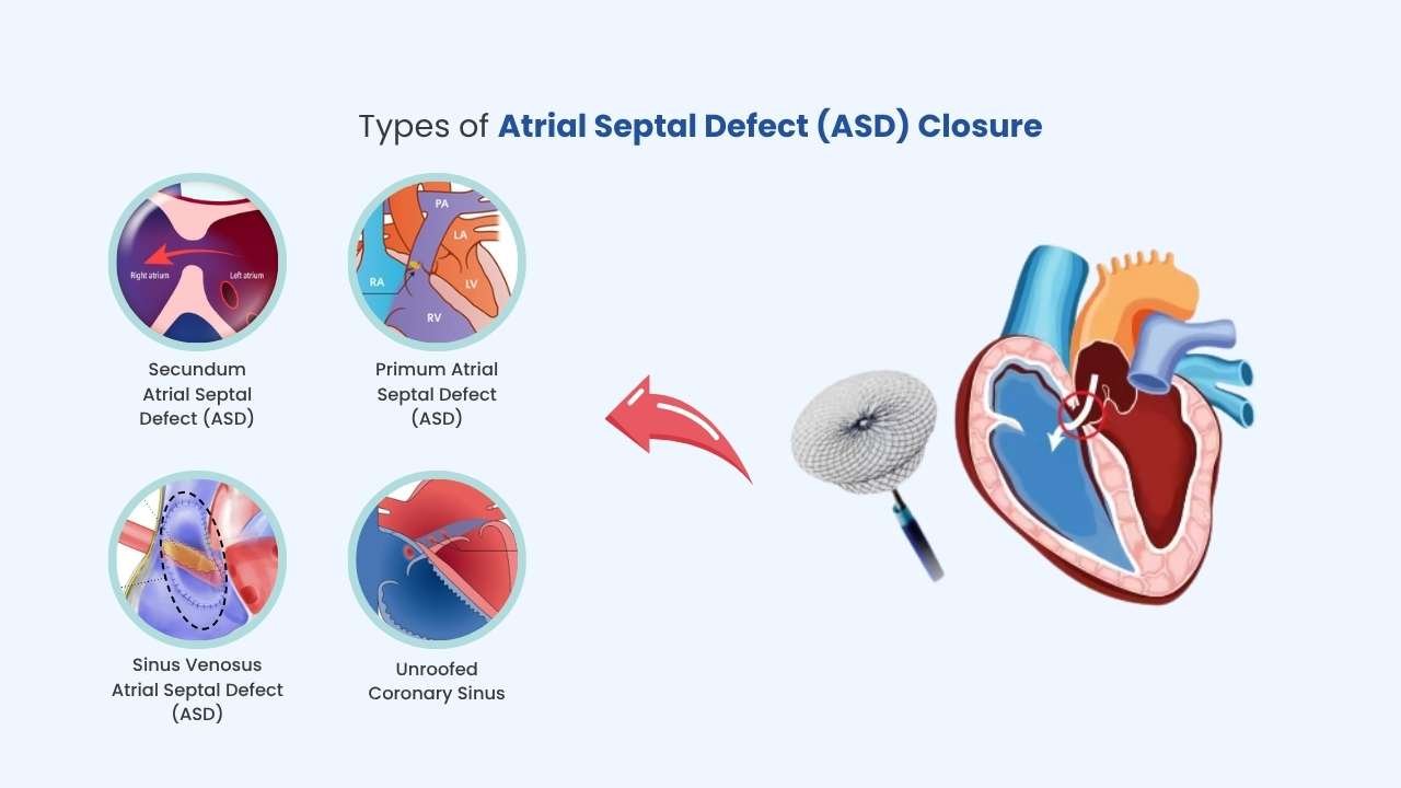 what are the types of atrial septal defect (asd) closure