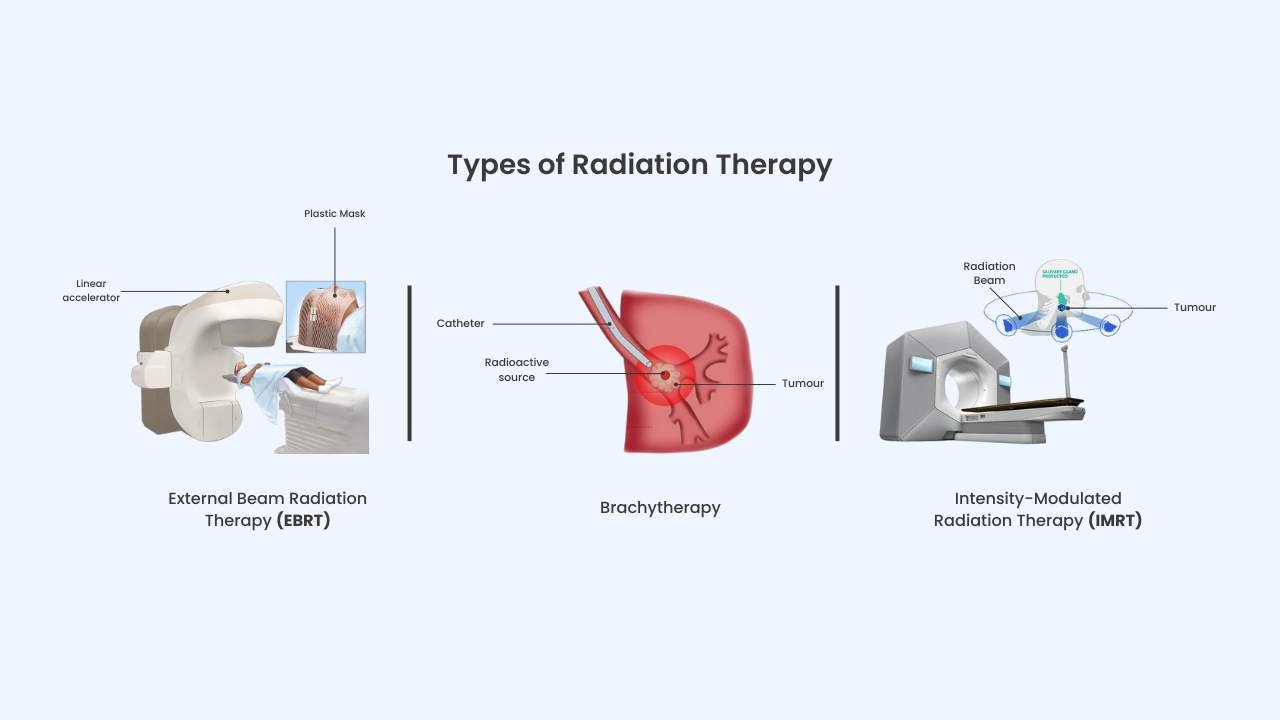 what are the types of radiation therapy 