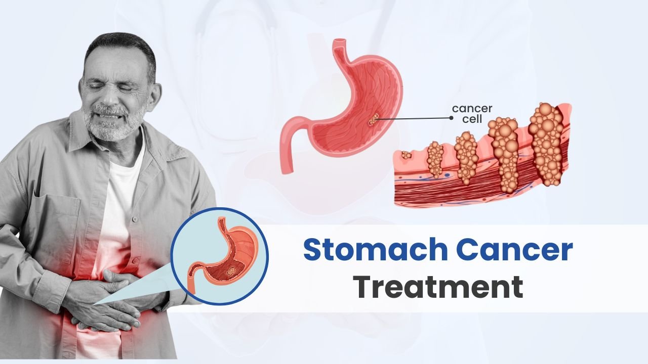 Stomach Cancer Treatment cost