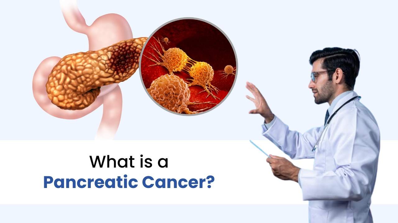 what is pancreatic cancer
