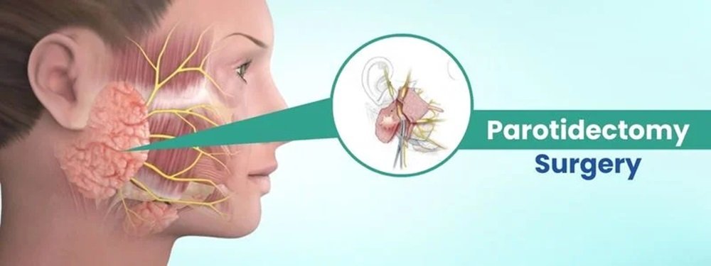 parotidectomy cost in india