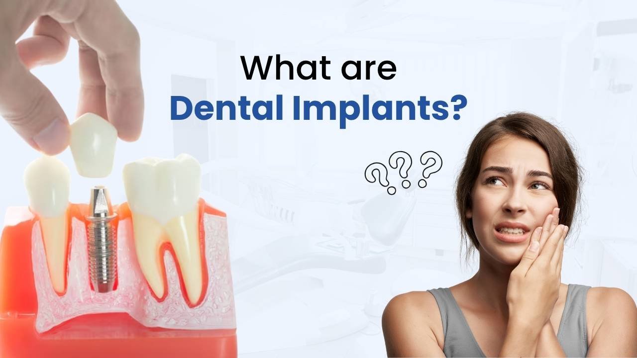 what are dental implant