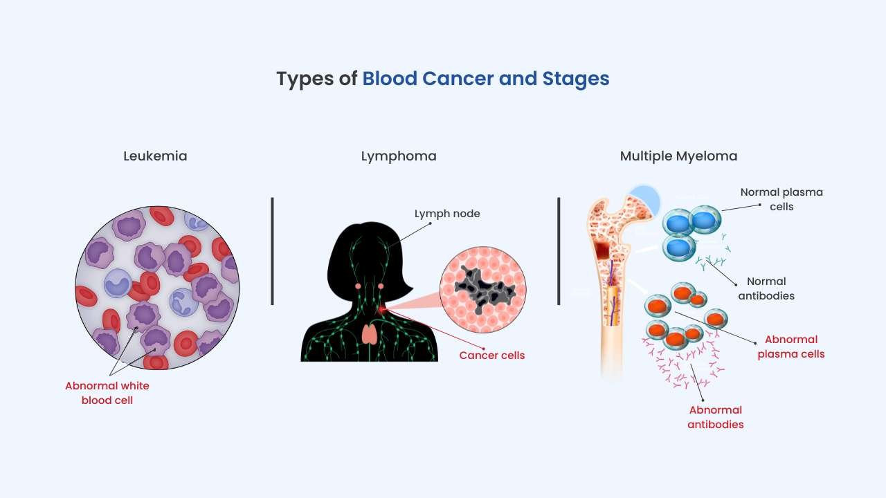 types of blood cancer and stage