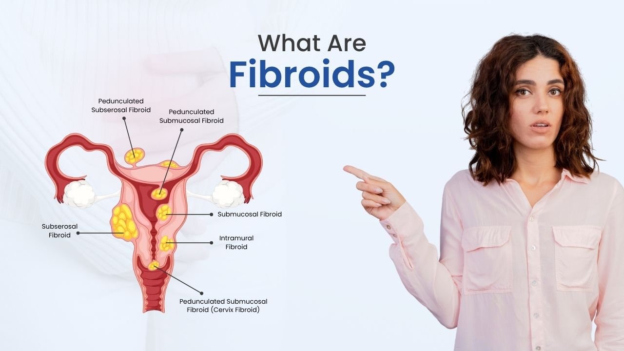 what are fibroids?