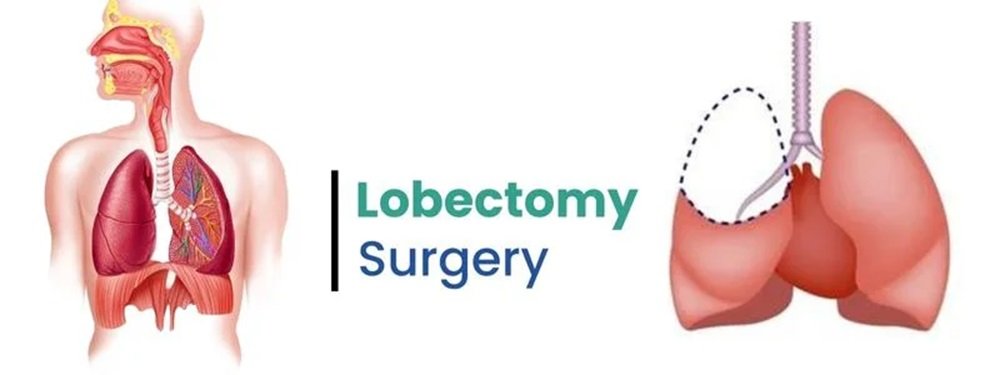 lobectomy surgery
