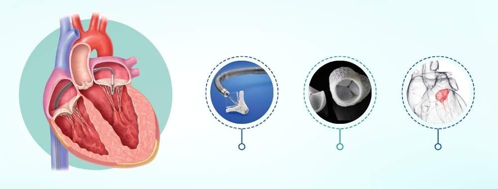 Technologies Used in India in Mitral Valve Replacement in India