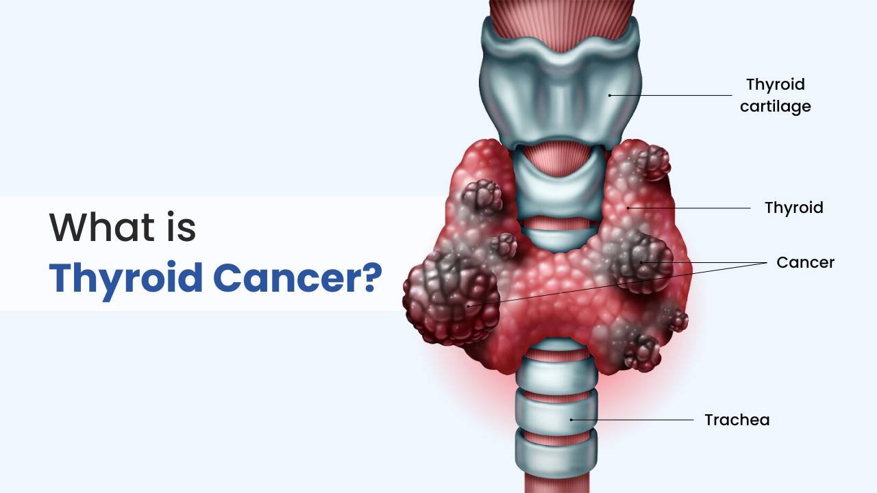 what is thyroid cancer