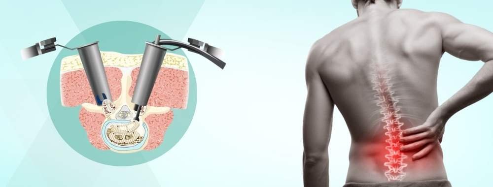 technologies used in india for transforaminal lumbar interbody fusion (tlif)