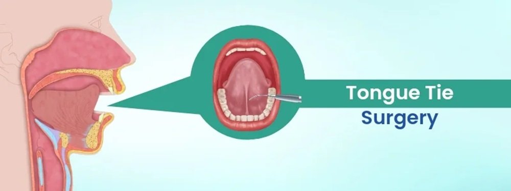 tongue tie surgery cost in india