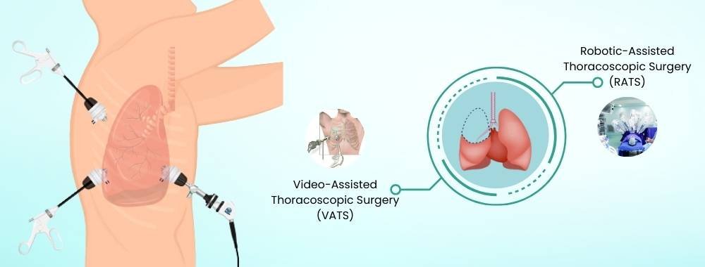 technologies used in India for lobectomy surgery