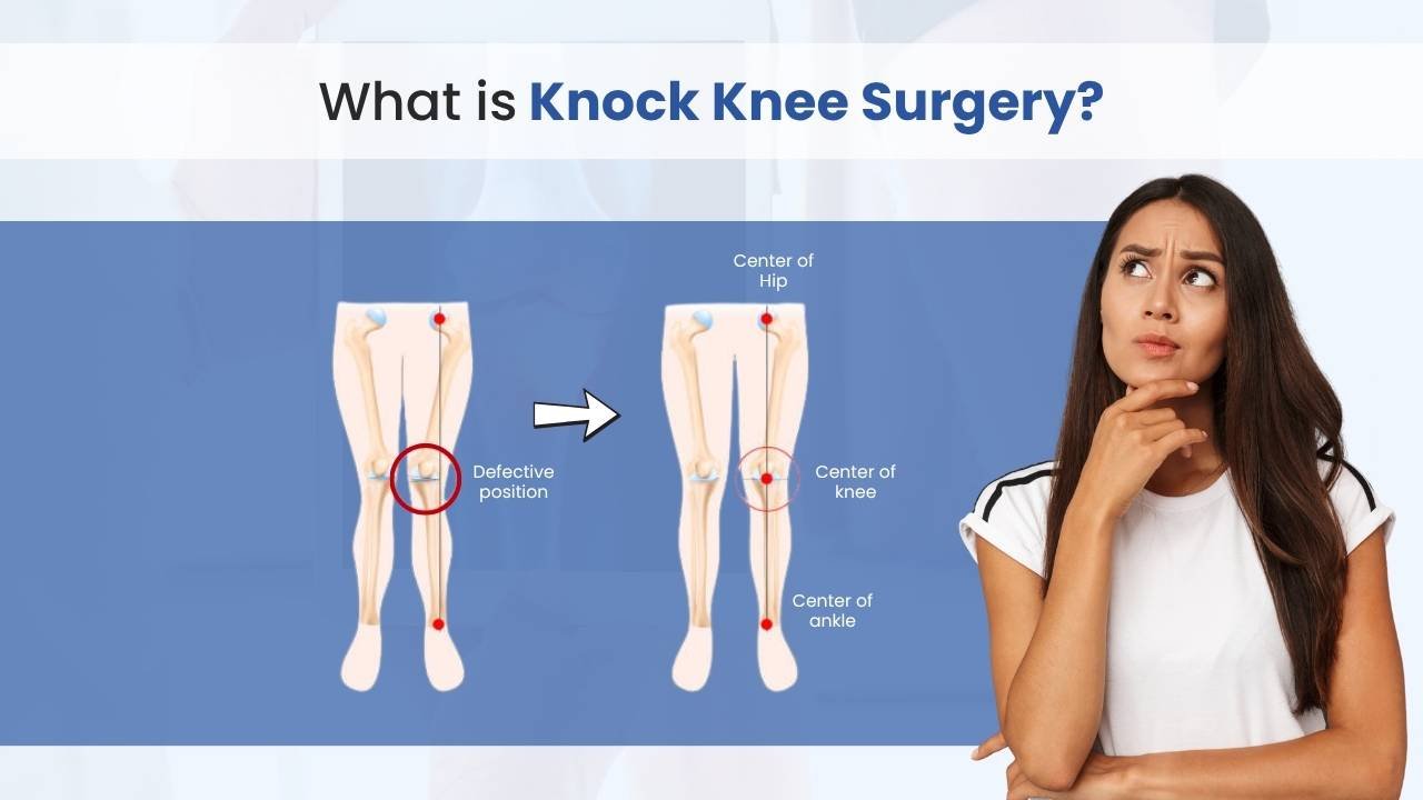 what is knock knee surgery