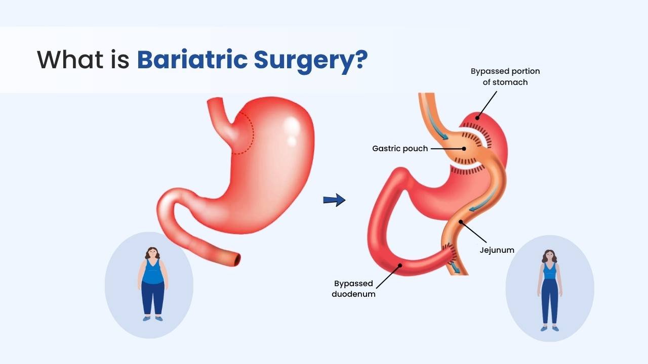 what is bariatric surgery