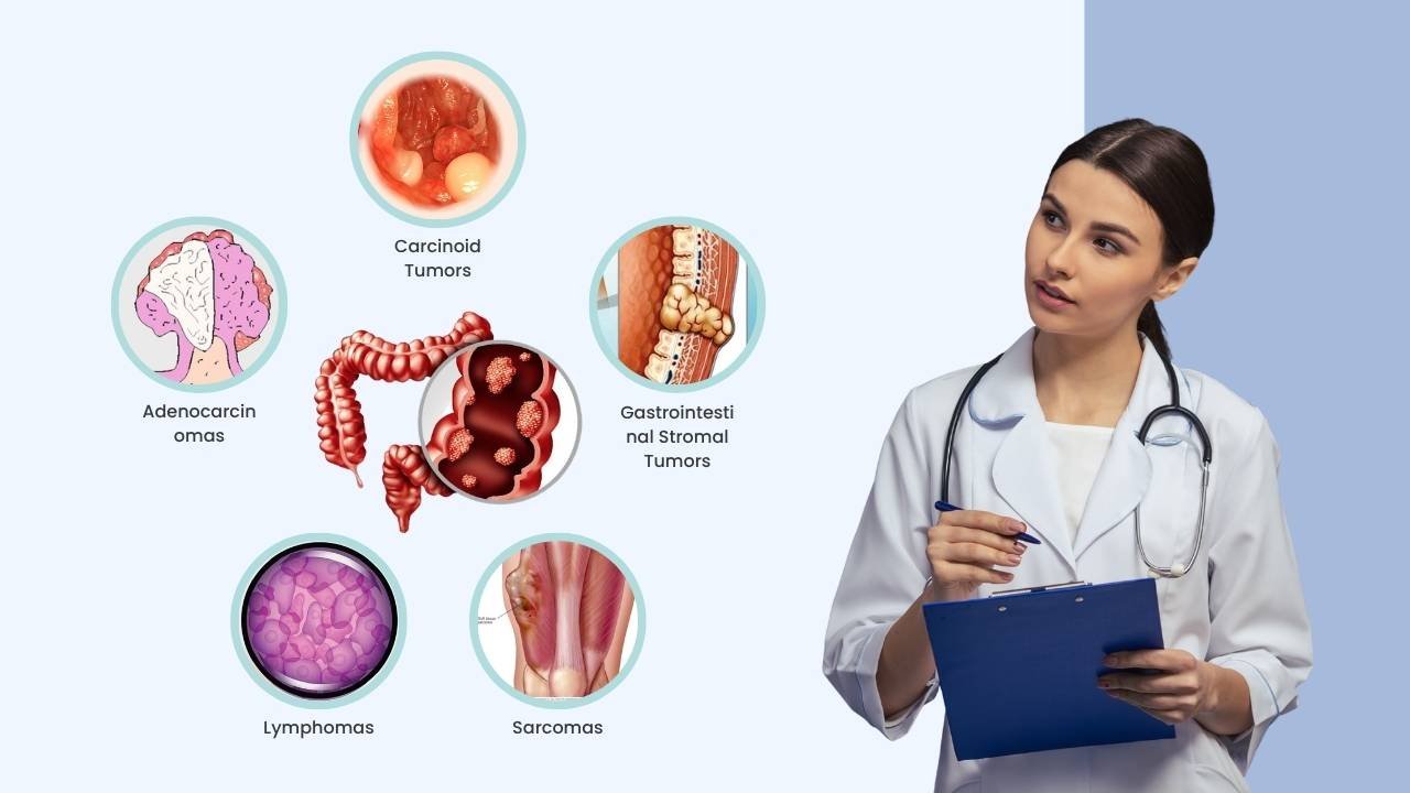 what are the types of colon cancer