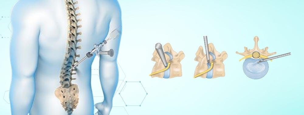 technologies used in india for lumbar spine fusion surgery