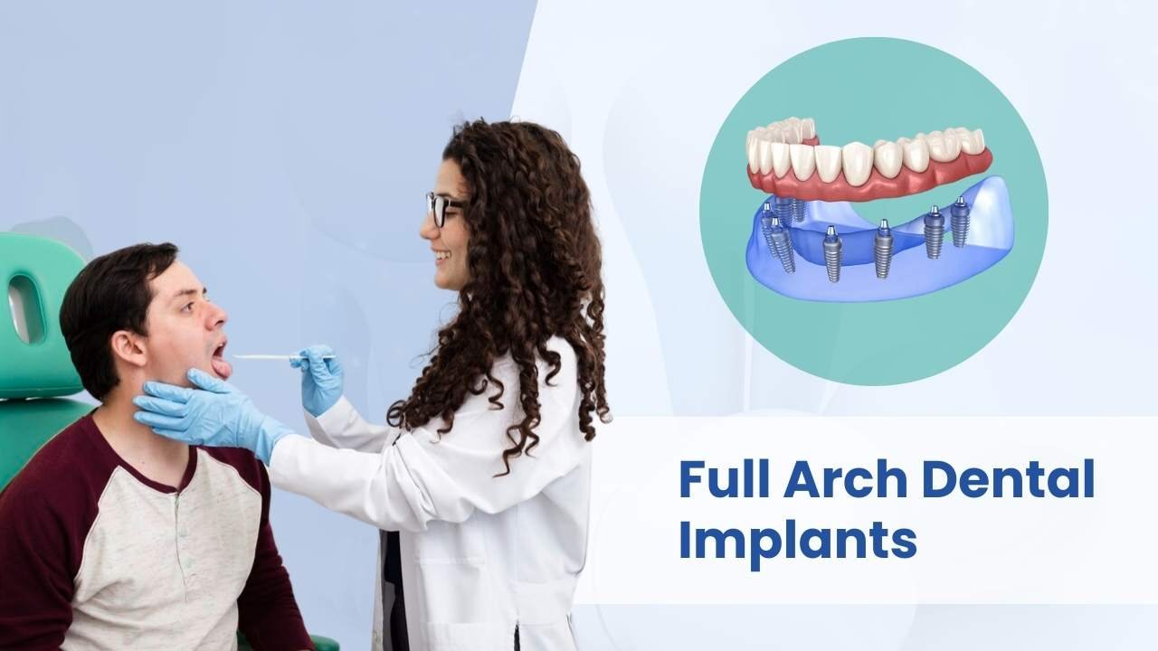 full arch dental dental implant