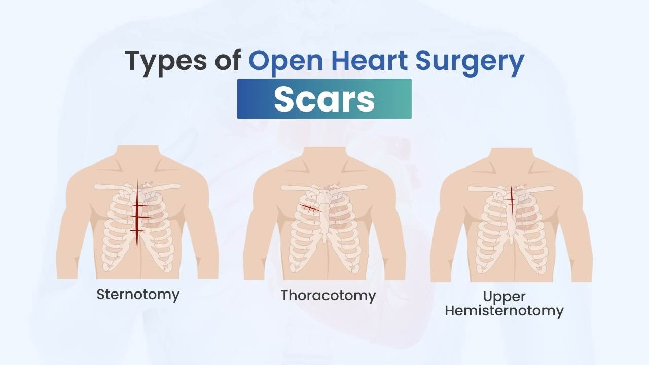 types of open heart surgery scar