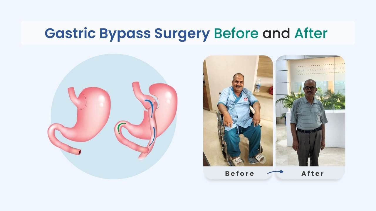 gastric bypass before and after